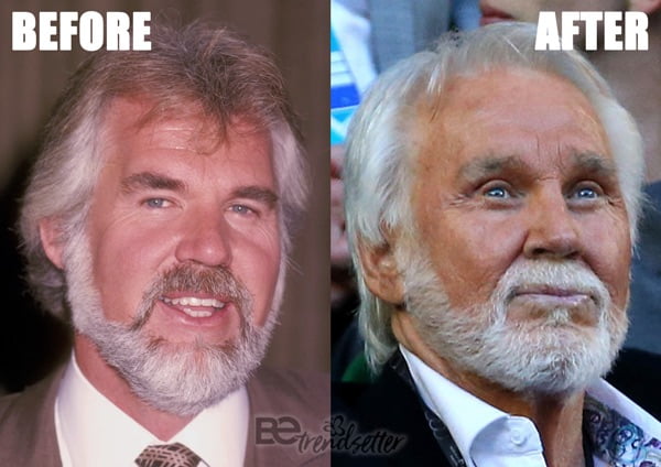 Kenny Rogers plastic surgery disaster