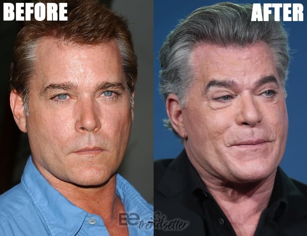 Ray Liotta plastic surgery disaster