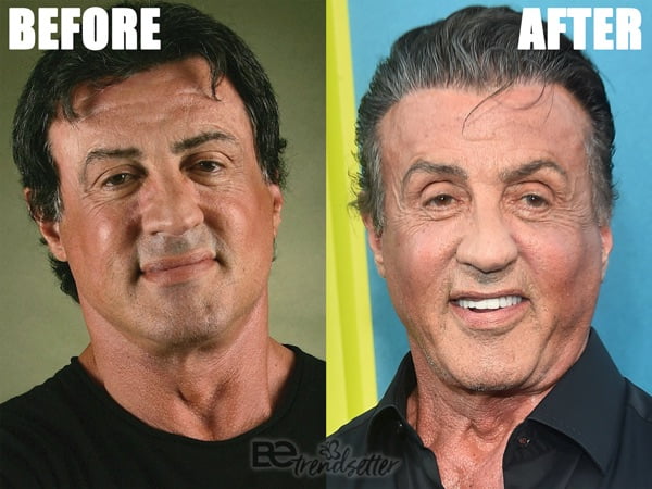 Sylvester Stallone plastic surgery disaster