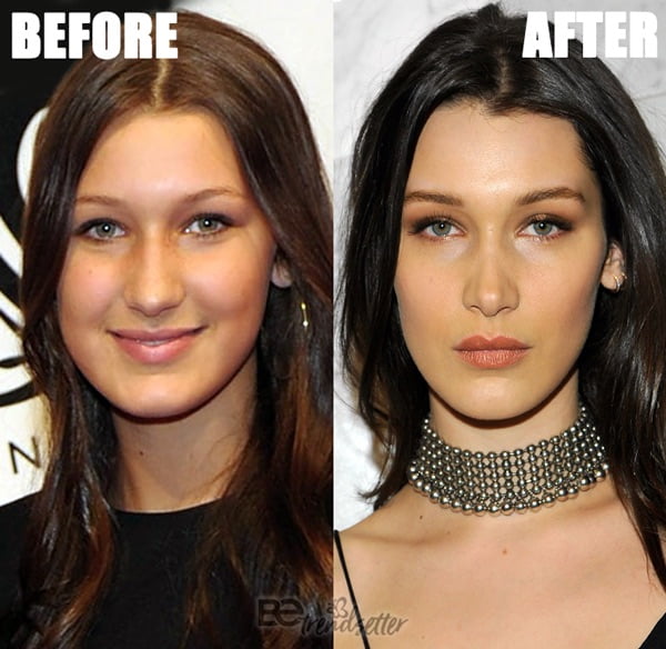 Bella Hadid Plastic Surgery Secrets Exposed 2020