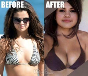Selena Gomez Plastic Surgery Revealed! Before and After