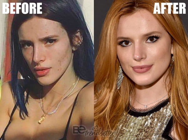 Bella Thorne acne scar surgery