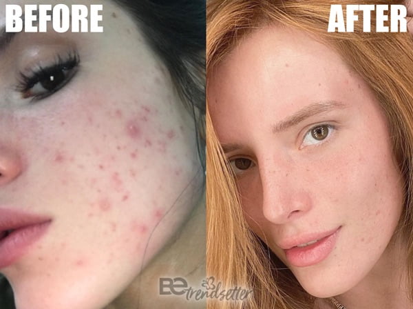 Bella Thorne Acne Treatment